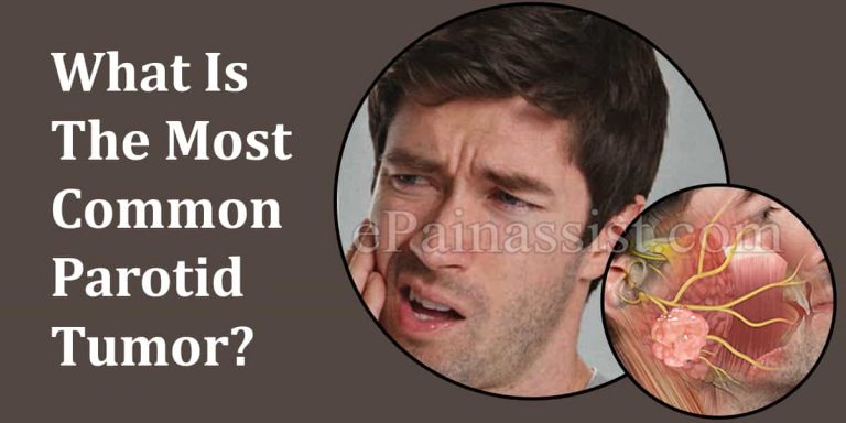 What Is The Most Common Parotid Tumor & How Do You Know If You Have It?