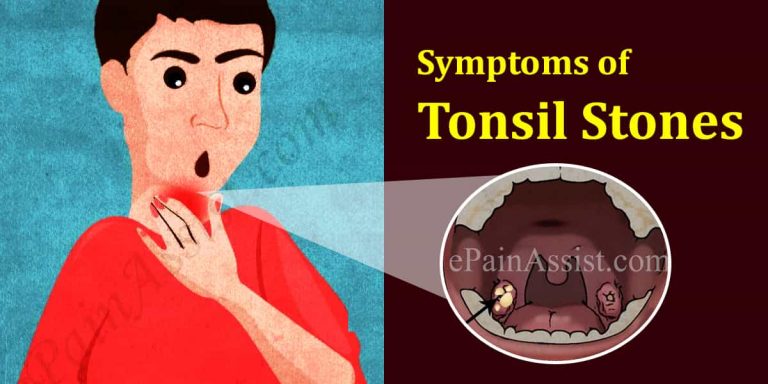 Tonsil Stones: Everything You Need To Know