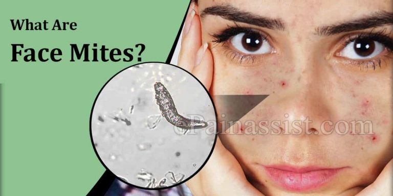 What are Face Mites (Demodex Folliculorum), Know its Causes and Treatment