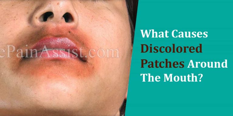 What Causes Discoloration Around The Mouth & How Can It Be Treated?