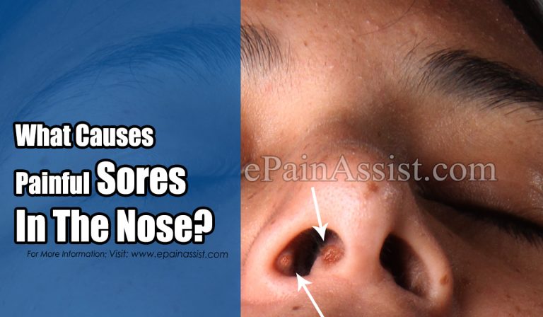 What Causes Painful Sores In The Nose & What To Do About It?