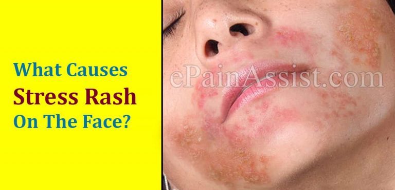 What Causes Stress Rash On The Face & How To Treat It?