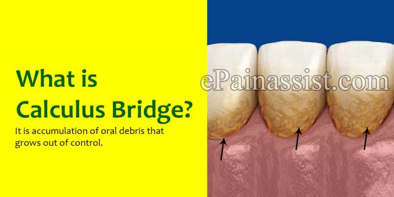 What is a Calculus Bridge: Side Effects, Removal, Prevention