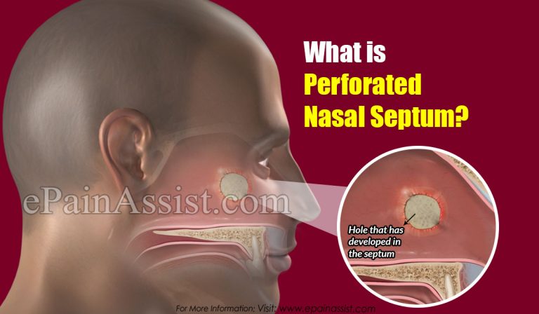 What is Perforated Nasal Septum: Symptoms, Causes, Diagnosis, Treatment, Recovery, Outlook