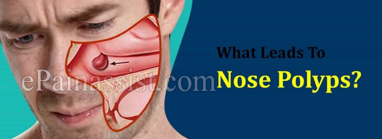 What Leads To Nose Polyps & Can It Be Cured?