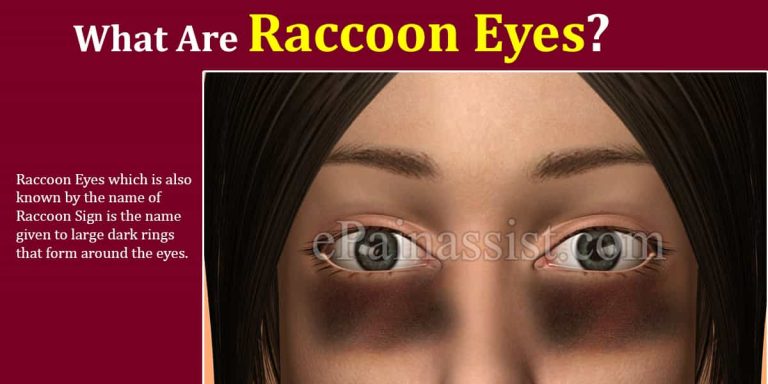 What Causes Raccoon Eyes & What Are Its Treatment Options?