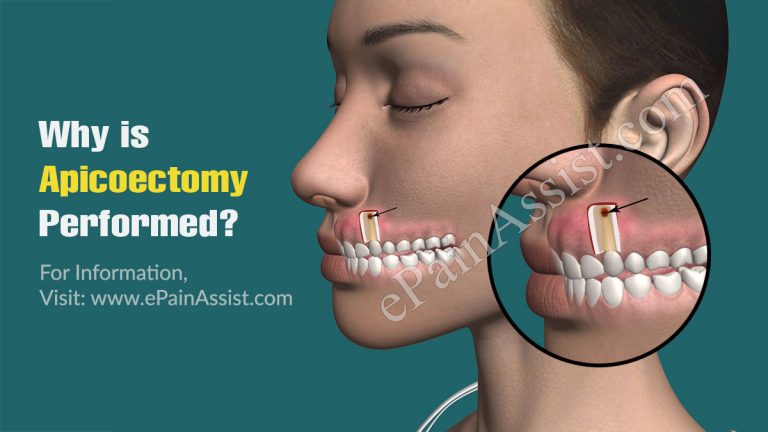 Apicoectomy: Why is it Performed, Procedure, Recovery, Risks and Complications