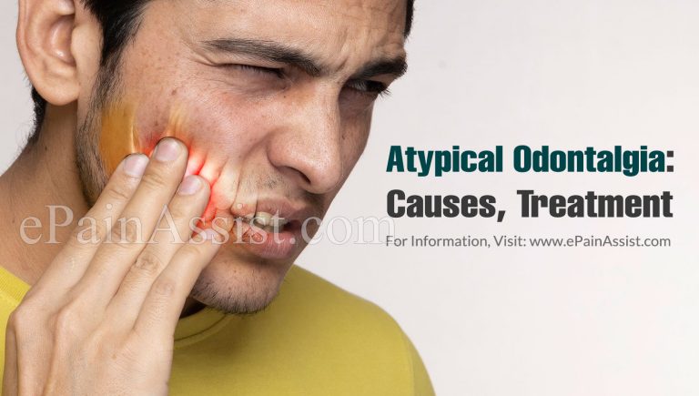 Atypical Odontalgia: Causes, Treatment, How Long Does It Last, Why is it Named “Atypical” Odontalgia?