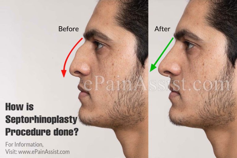 How is Septorhinoplasty Procedure done, Know its Risks, Side Effects and What Happens After Septorhinoplasty?