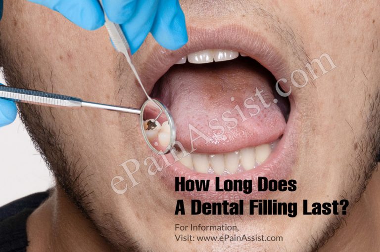 How Long Does A Dental Filling Last?