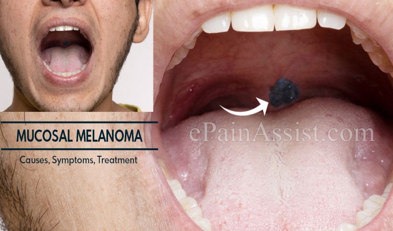 Mucosal Melanoma: Stages, Causes, Symptoms, Treatment and Complications