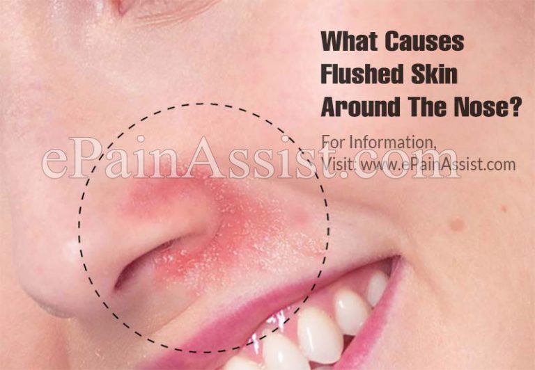What Causes Flushed Skin Around The Nose and How To Treat It?