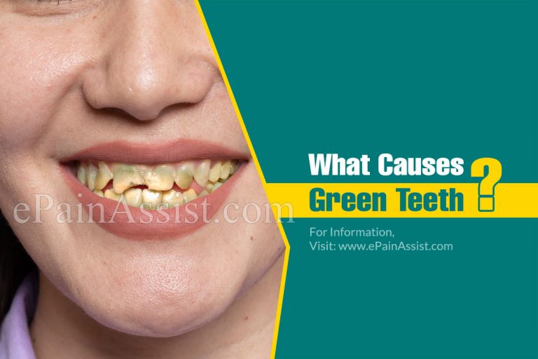 What Causes Green Teeth & How To Get Rid Of It?