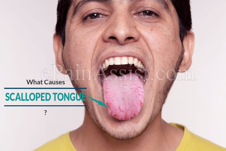 What Causes Scalloped Tongue and How To Treat It?