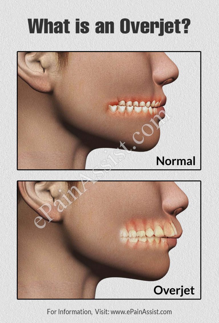 Overjet: Causes, Signs, Symptoms, Treatment, How is Overjet Different From An Overbite?