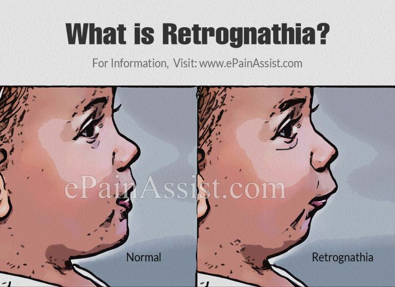 What is Retrognathia: Causes, Complications and its Treatment in Babies, Children, Adolescent and Adults