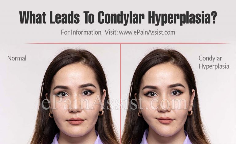 What Leads To Condylar Hyperplasia & How Is It Diagnosed and Treated?