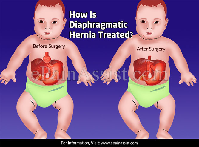 How Is Diaphragmatic Hernia Treated?