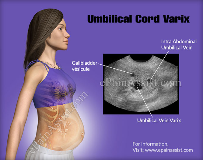 Umbilical Cord Varix Umbilical Cord Varix