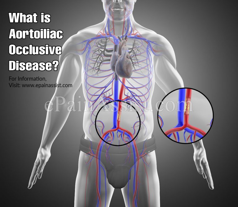Aortoiliac Occlusive Disease: Causes, Symptoms, Treatment, Prevention, Diagnosis