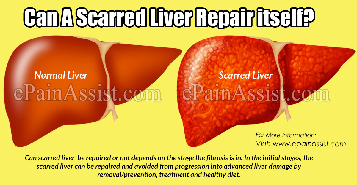 Can a Scarred Liver repair itself?