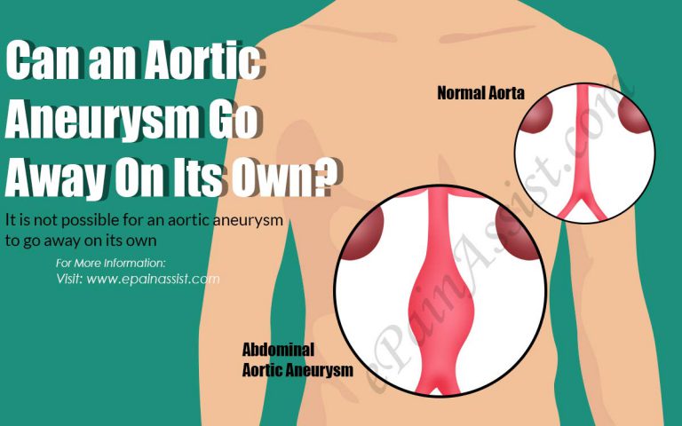 Can an Aortic Aneurysm Go Away On Its Own?