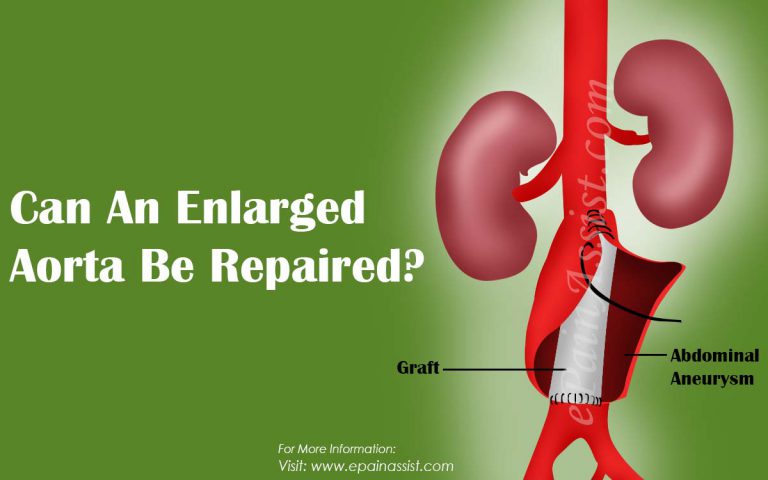 Can An Enlarged Aorta Be Repaired?