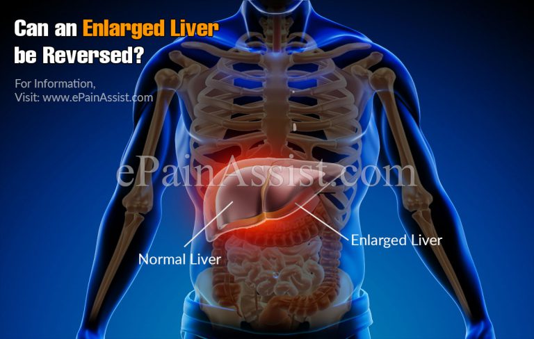 Can An Enlarged Liver Be Reversed?