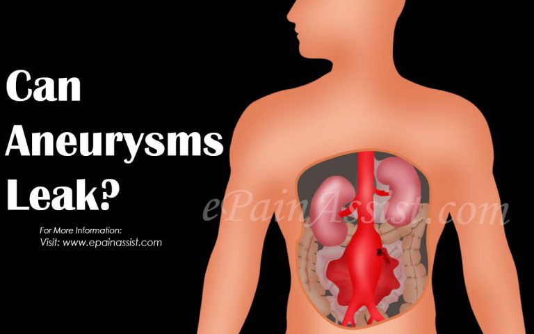 Can Aneurysms Leak?