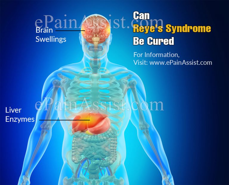 Can Reye’s Syndrome Be Cured?