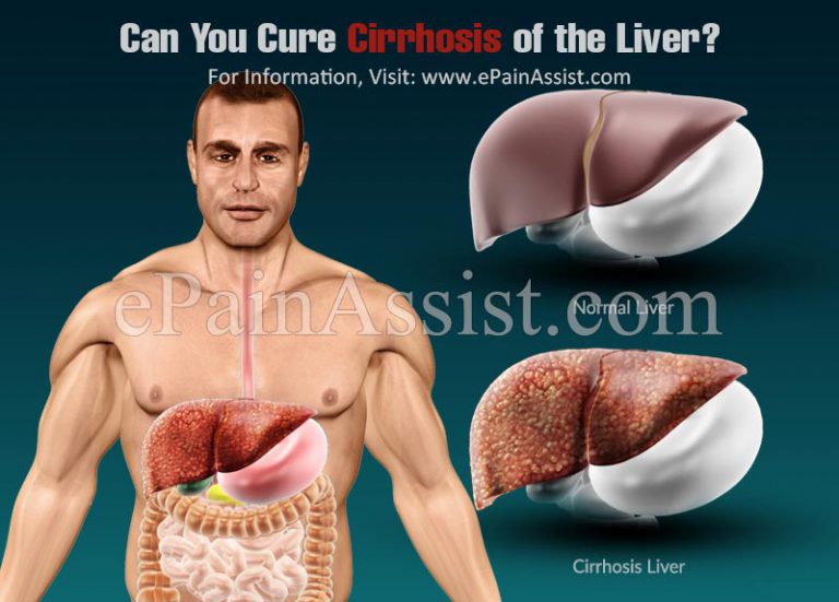 Can You Cure Cirrhosis of the Liver?