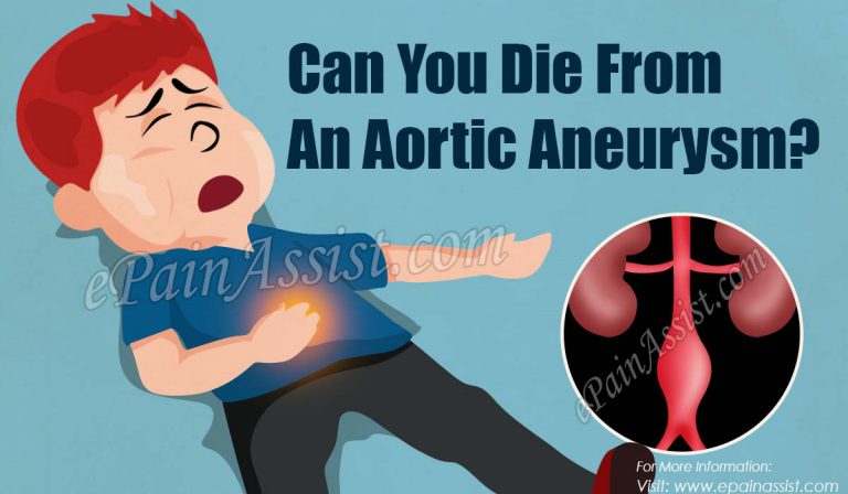 Can You Die From An Aortic Aneurysm?