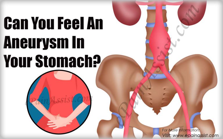 Can You Feel An Aneurysm In Your Stomach?