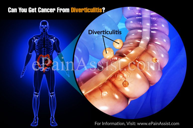 Can You Get Cancer From Diverticulitis?