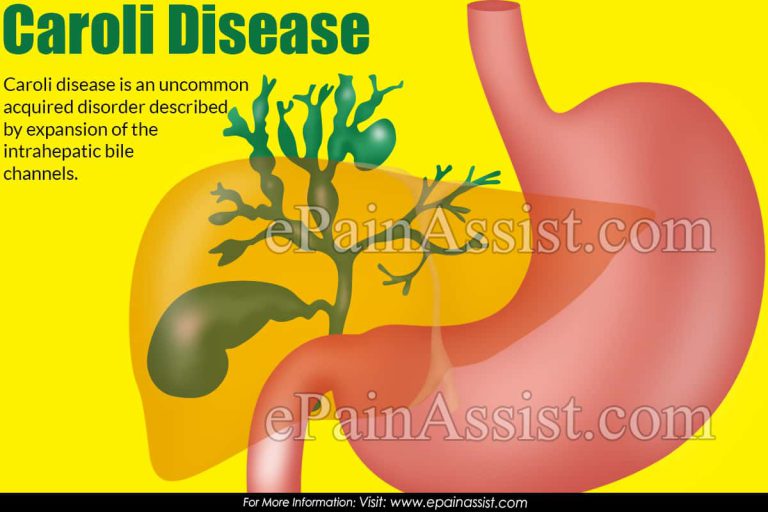 Caroli Disease: Symptoms, Causes, Treatment, Prognosis, Diagnosis, Epidemiology