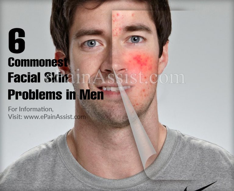 6 Commonest Facial Skin Problems in Men