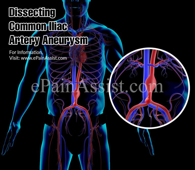 Dissecting Common Iliac Artery Aneurysm: Causes, Symptoms, Treatment