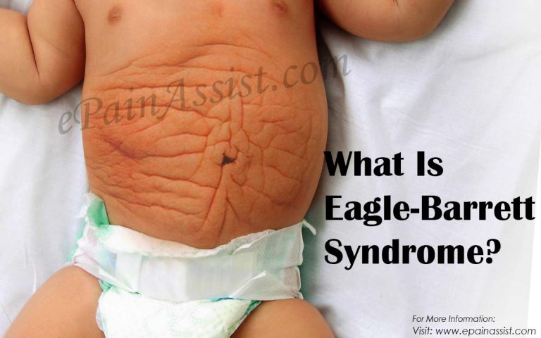 What is Eagle-Barrett Syndrome: Causes, Symptoms, Treatment