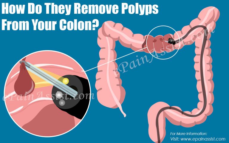 How Do They Remove Polyps From Your Colon?