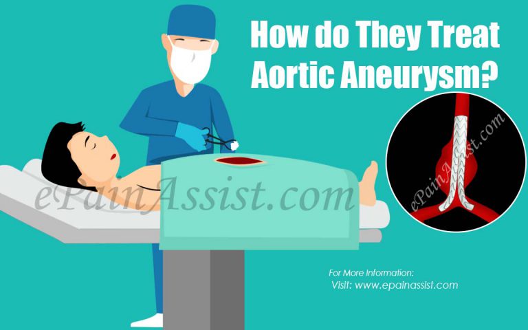 How do They Treat Aortic Aneurysm?