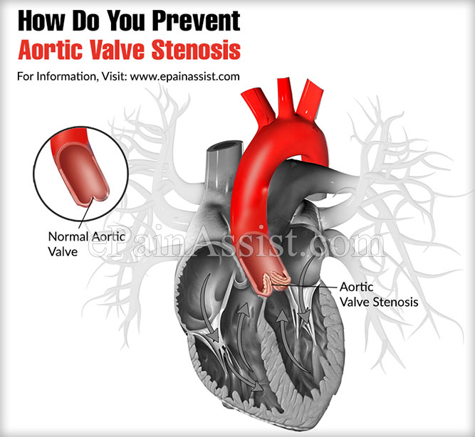 How Do You Prevent Aortic Valve Stenosis?