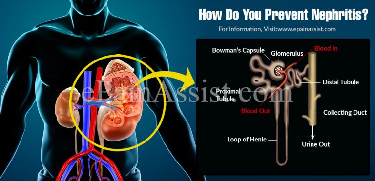 How Do You Prevent Nephritis?