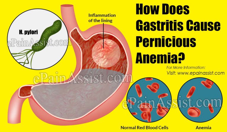 How Does Gastritis Cause Pernicious Anemia?