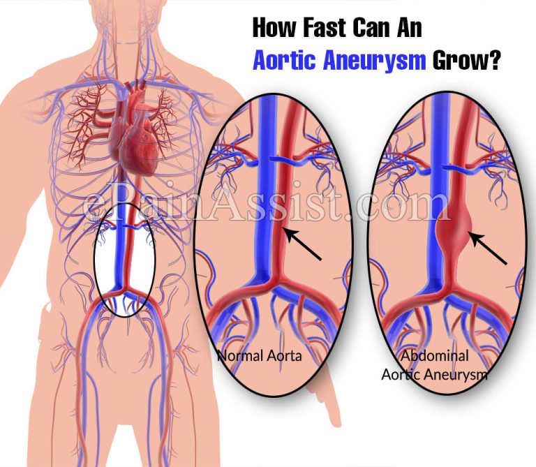 How Fast Can An Aortic Aneurysm Grow?