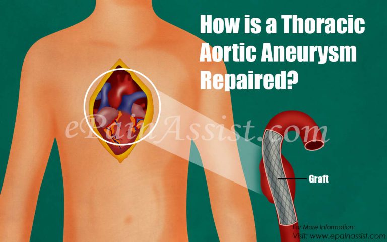 How is a Thoracic Aortic Aneurysm Repaired?