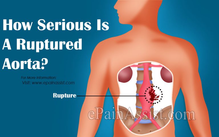 How Serious Is A Ruptured Aorta?