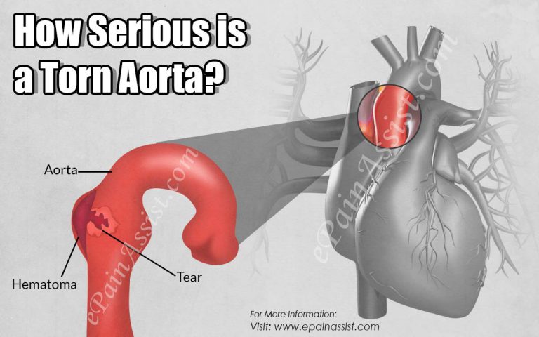 How Serious is a Torn Aorta?