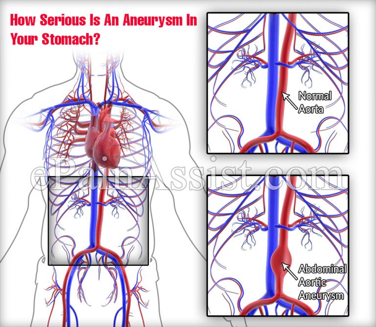 How Serious Is An Aneurysm In Your Stomach?