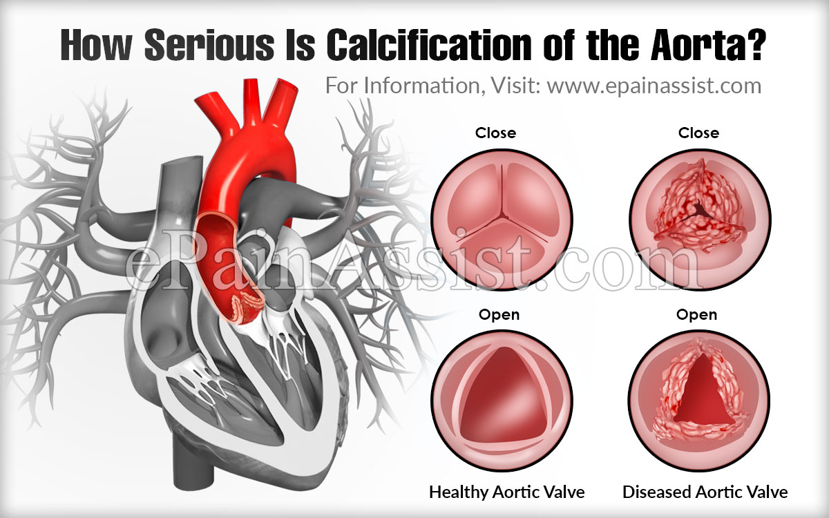 How Serious Is Calcification of the Aorta?