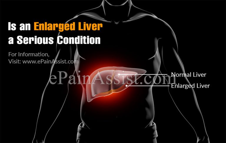Is An Enlarged Liver a Serious Condition?